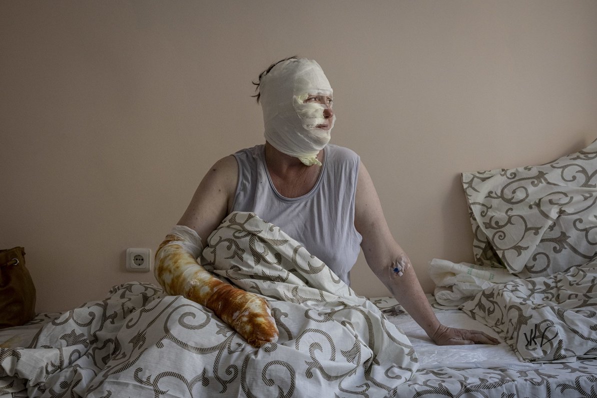 49 gadus vecā Rina Volkova guvusi smagus apdegumus, kad Krievijas karaspēks ar raķetēm apšaudīja civ...