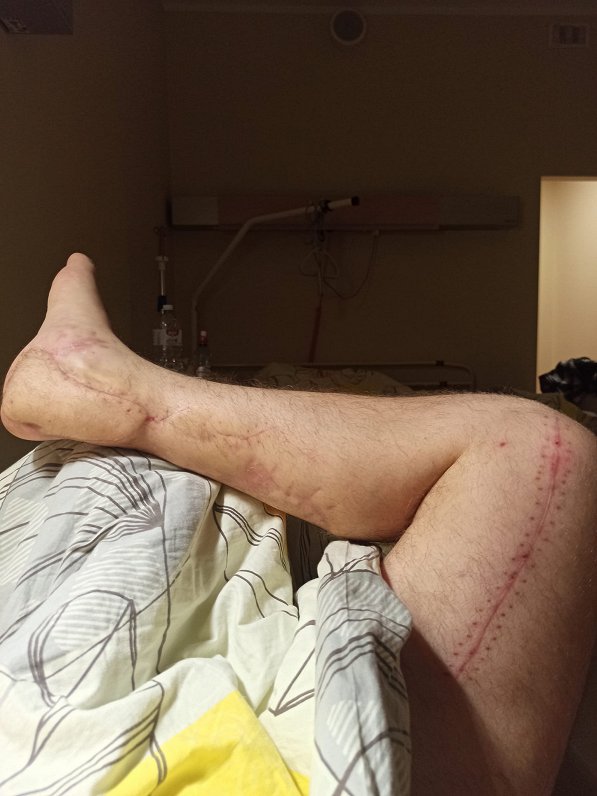 Nikolaja kāja pēc operācijas