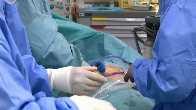 Stradiņa slimnīcā​​​​​​​ donora nieri pirmo reizi izņem laparaskopiski