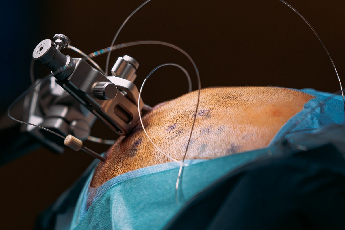 Tā izskatījās Rēzijas galva ar implantētiem elektrodiem izmeklējuma veikšanai pirms vairāk nekā gada...