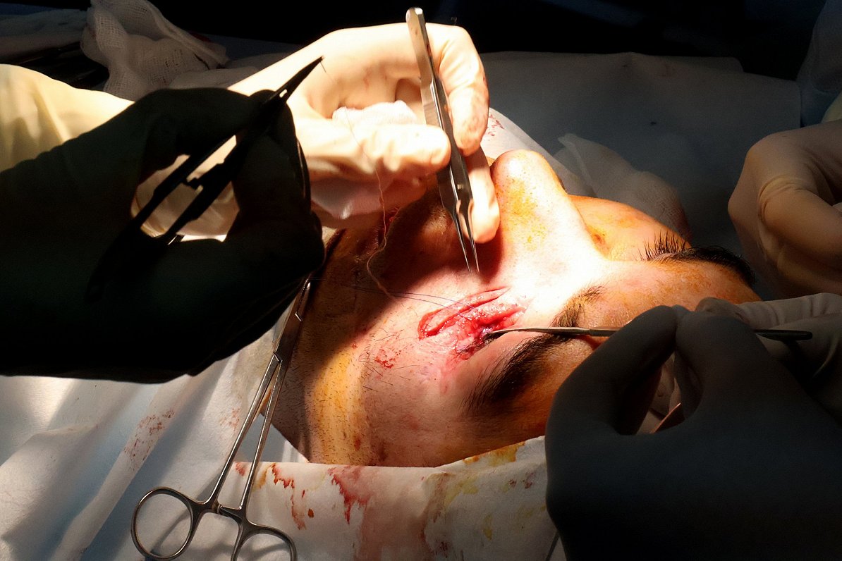 Пластическую операцию раненому проводит хирург-волонтер из США. Украина, Киев, 19.10.2023.